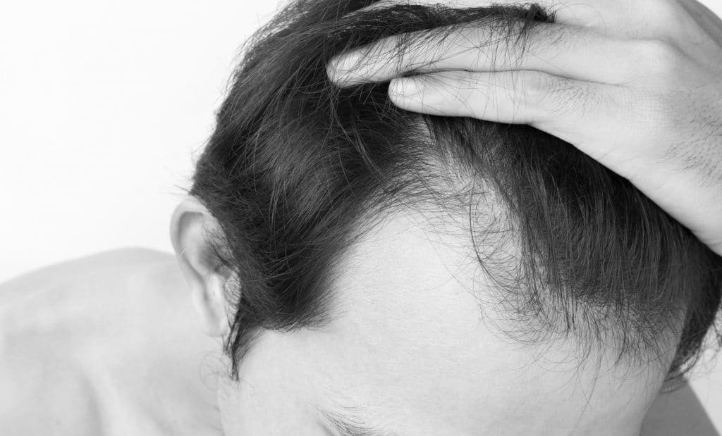 Greffe de Cheveux FUE Lyon